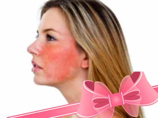 Заболевание кожи лица розацеа: как лечить?