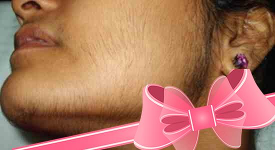 Почему растет борода у женщин и как избавиться?