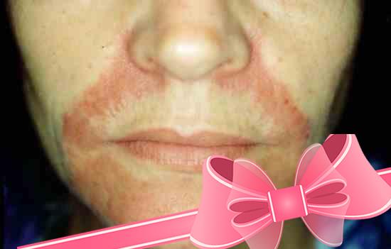 Способы лечения перорального дерматита на лице
