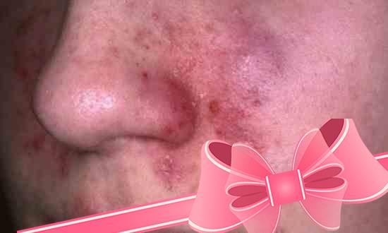 Экзема на коже лица: симптомы и лечение